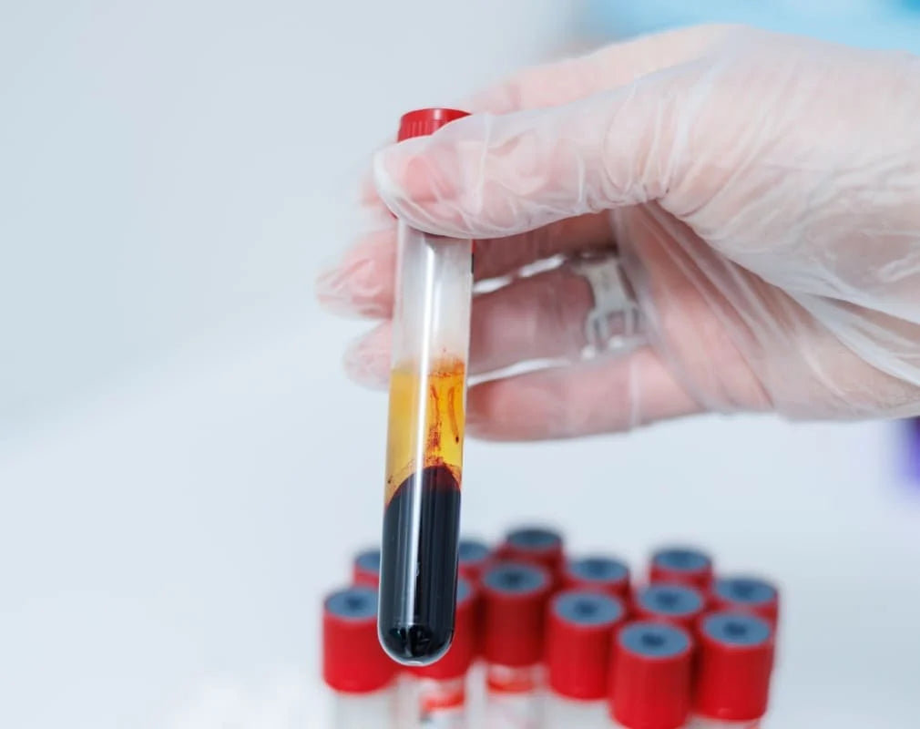 Tube prélèvement sanguin analyse médicale santé diagnostic 