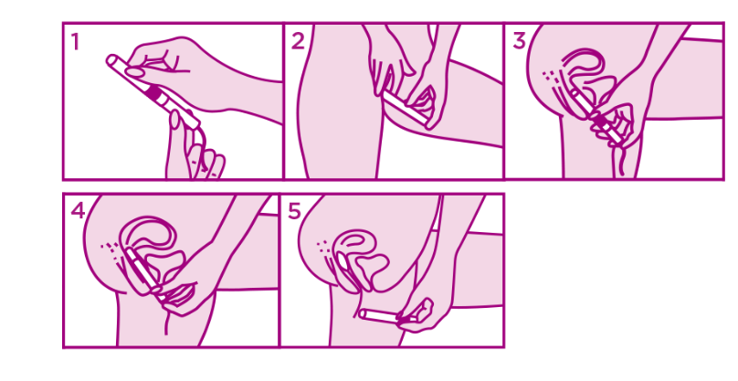 Étapes d’utilisation d’un tampon avec applicateur illustrées en 5 étapes